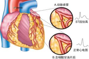 专家：超80%的猝死发生在院外，多数猝死是可以预防的