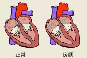 中国房颤日｜脑卒中风险增加5倍！中国有百万人患病还不自知