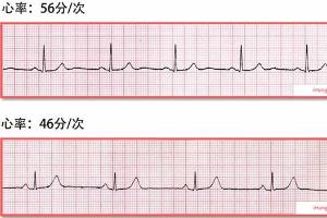 如何看懂动态心电图报告（下）：房扑、房颤严重吗