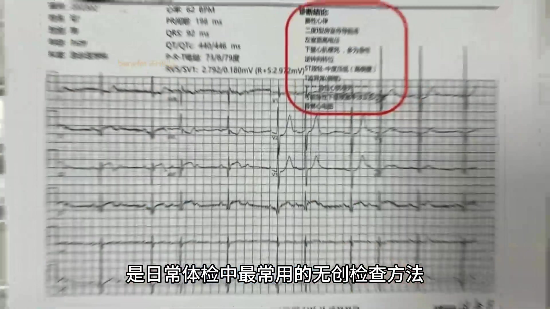 心血管说第三期：心电图三兄弟，哪个抓“偷心贼”最棒！