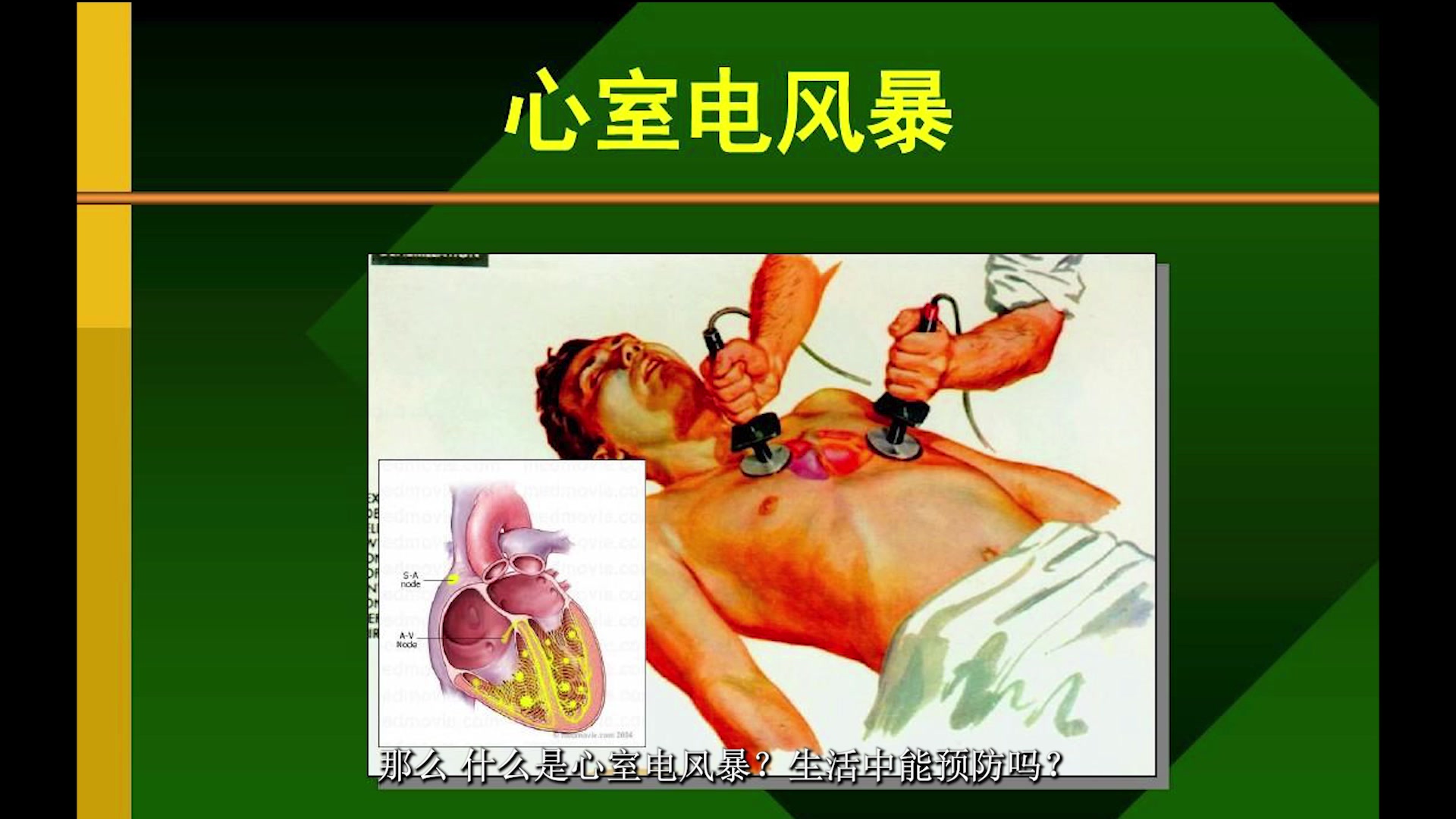 心血管说11期：比台风更可怕的“心室电风暴”，三高及老年人应小心预防