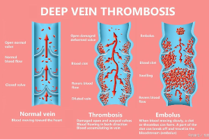 世界保健日&世界血栓日：揭秘血栓的真相与防护